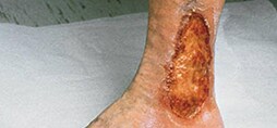 Chronic wound