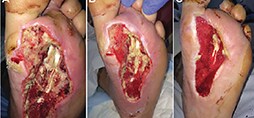 Acute and traumatic wound