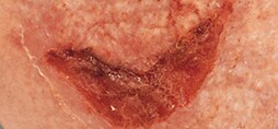 medical adhesive-related skin injury (MARSI)