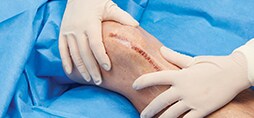 surgical wound infection