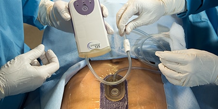 PREVENA™ Therapy
