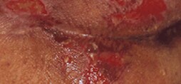 pressure injury