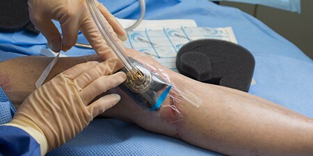 Clinician applying V.A.C. ® GRANUFOAM™ Dressing to patient knee
